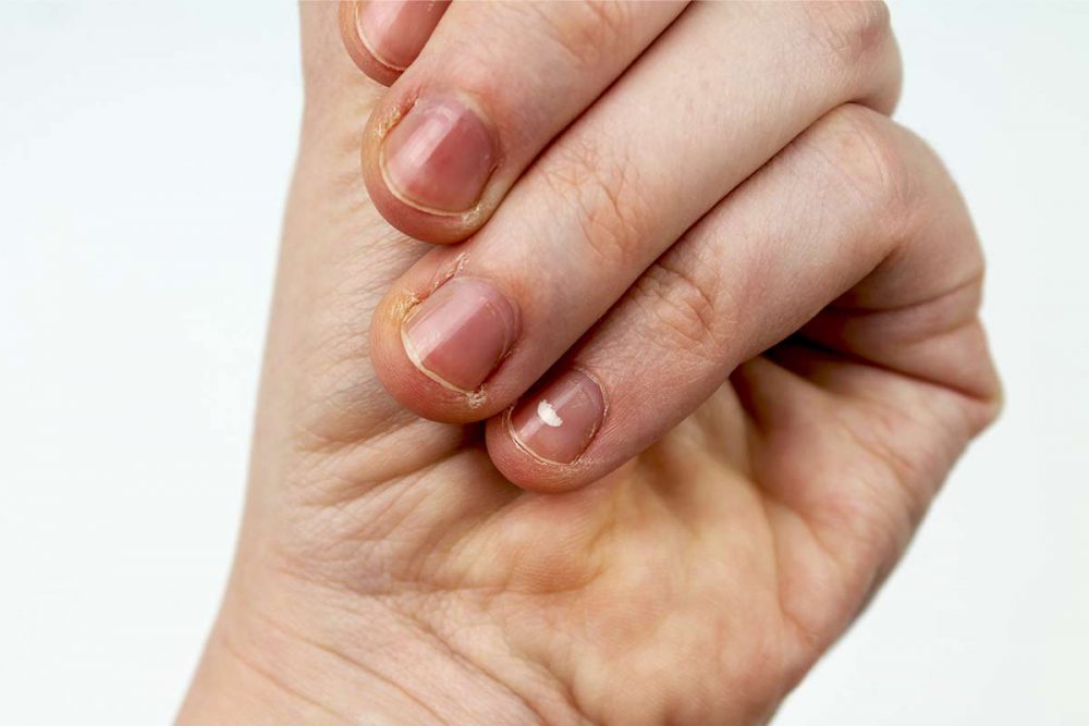 Infecciones por hongos en la piel y las uñas