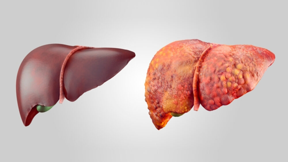 Hígado graso: Qué es y cómo deshacerse de él