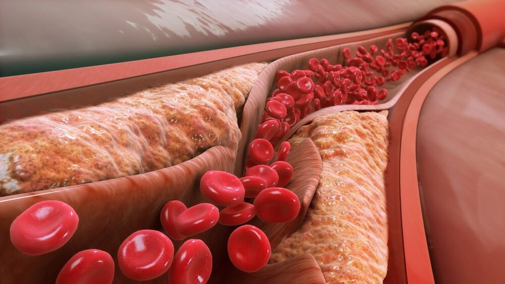 Por qué el colesterol alimenticio no importa (para la mayoría de las personas)