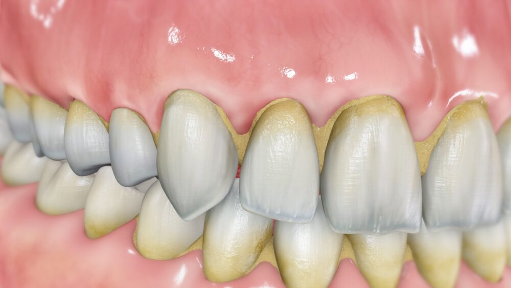 ¿Cómo afecta el sarro a los dientes y las encías?